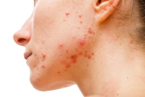 10 Points No One Ever Tells You About: Hormonal Pimples