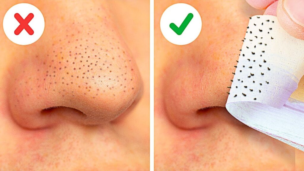The way to Safely Banish Blackheads?