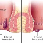 Hemorrhoid Pain Relief