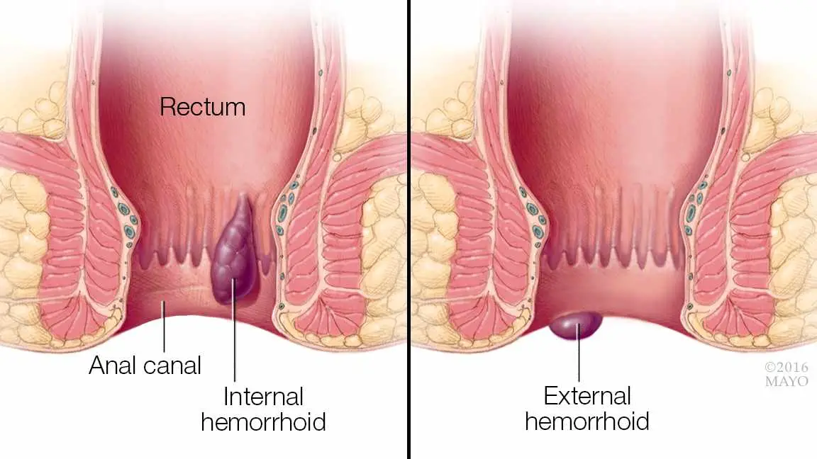 Hemorrhoid Pain Relief
