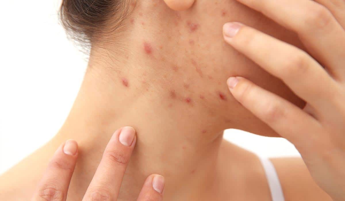 Pimples All through Being pregnant: Causes and Residence Remedies