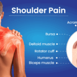 What is Shoulder Pain